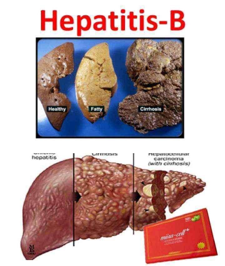 Miira-cell+ on Hepatitis B solution for sale in Kampala - Yilick